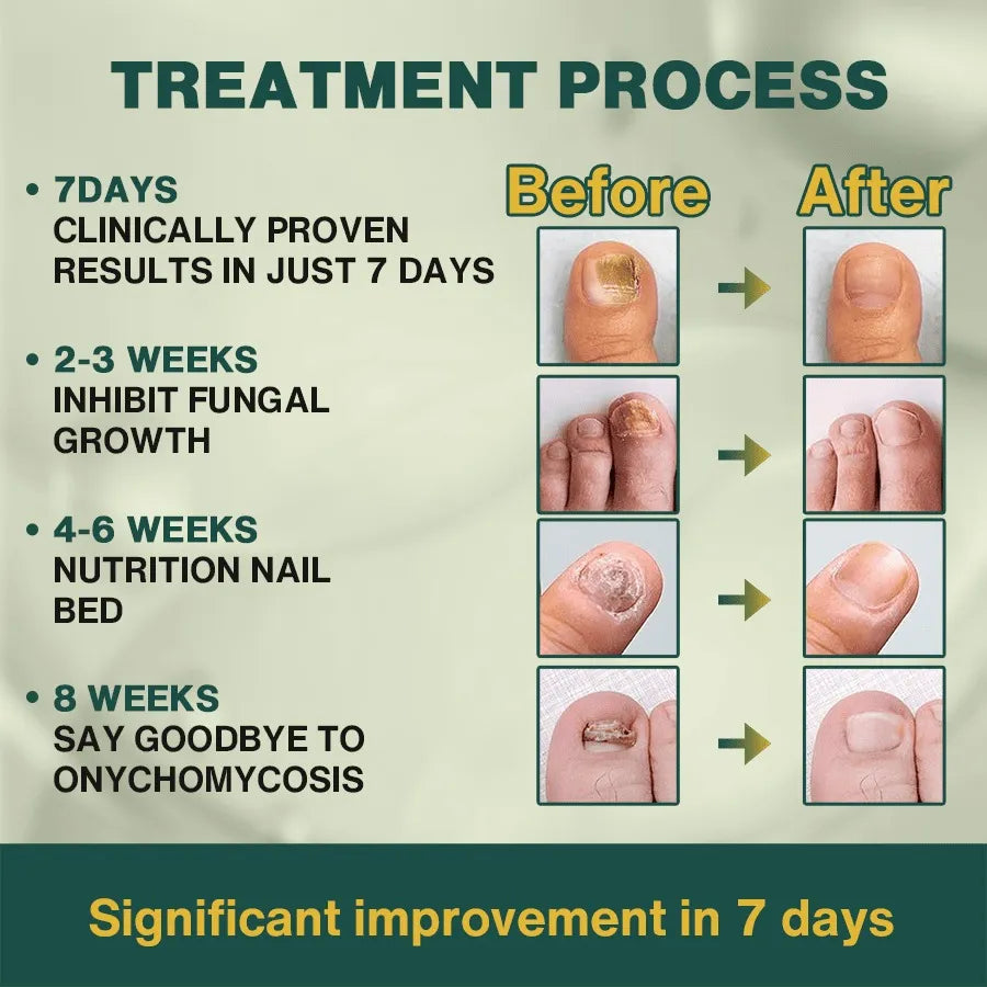 Nail Fungus Treatment | Ginger & Herbal Blend