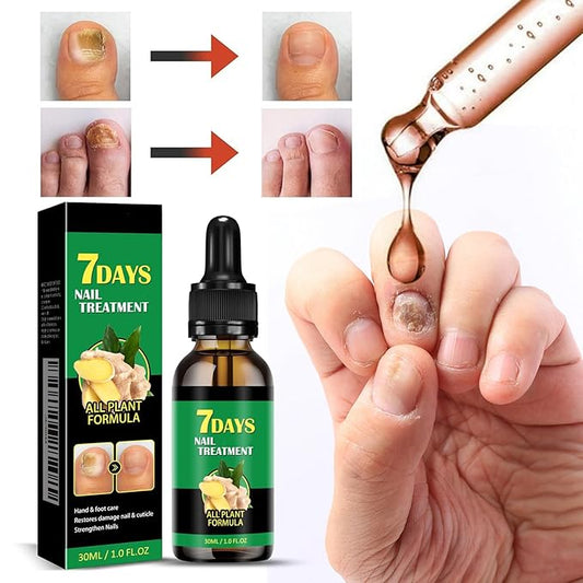 Nail Fungus Treatment | Ginger & Herbal Blend