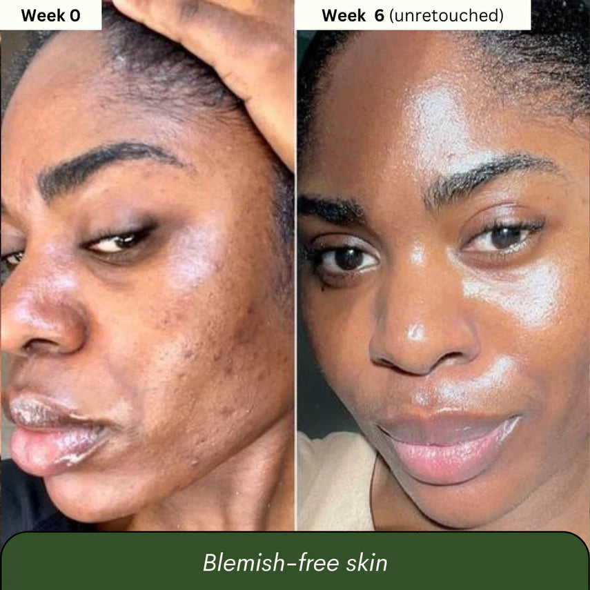 Advanced Turmeric Kojic Acid Soap